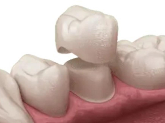 Emax Zirconia Dental Lab
