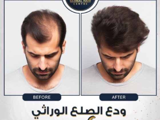 Global Hair Centre