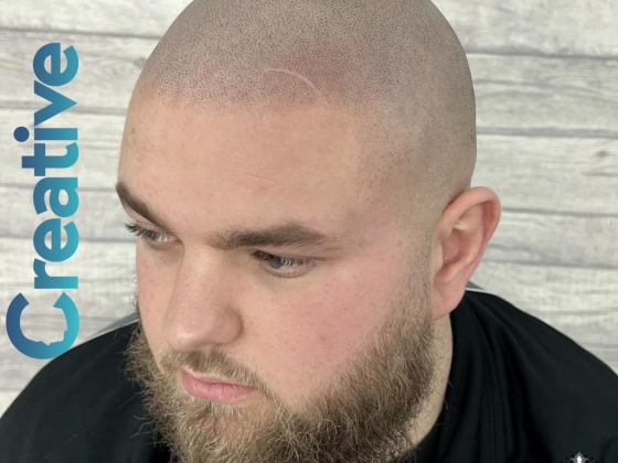 Creative Scalps